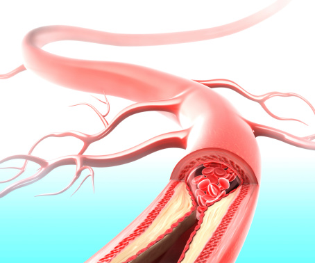 FDA Label Change on Approved Testosterone Products: Blood Clots Unrelated to Polycythemia