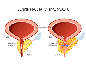 Aquablation Studied as Enlarged Prostate Treatment